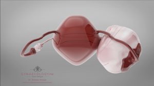 Ovarian-cyst